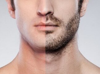 Transplante de barba: Saiba como é feito o procedimento