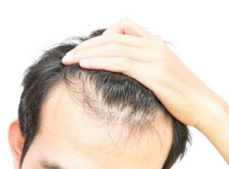 Quanto tempo dura o implante de cabelo?