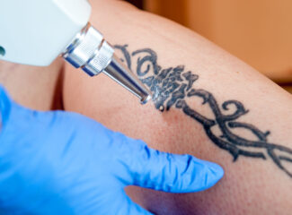 Mitos e verdades sobre remoção de tatuagem a laser