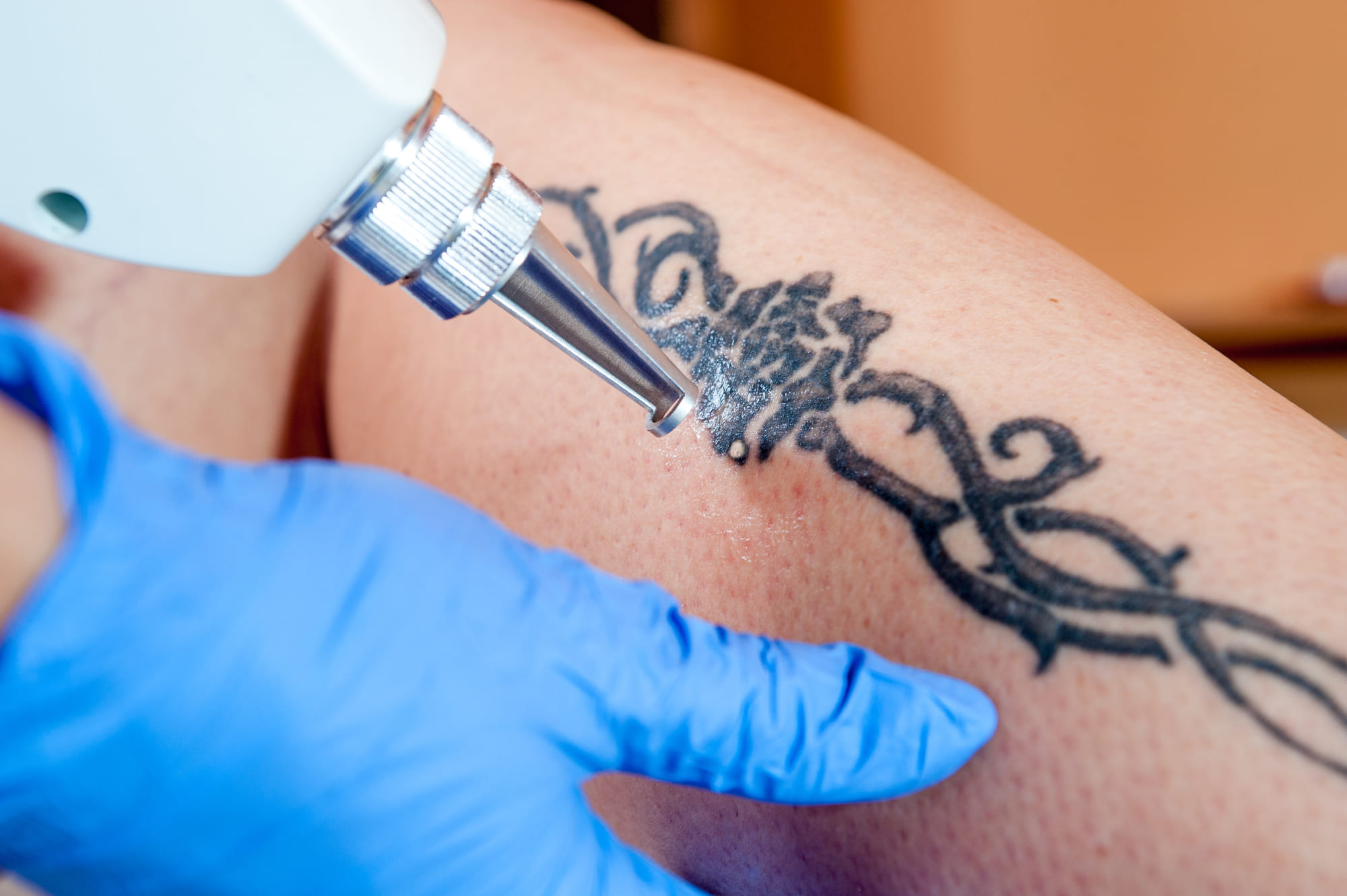 imagem de uma perna realizando a remoção de tatuagem a laser