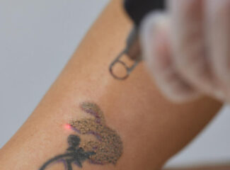 Nem toda tatuagem é para sempre: como o laser PicoWay remove pigmentos antigos e resistentes