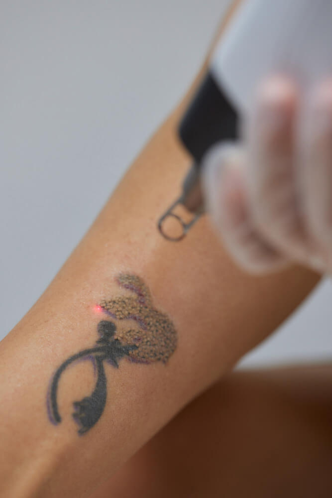 braço com tatuagem e tendo aparelho laser apontando para tatuagem