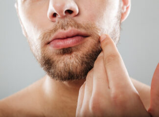 Barba falha depois dos 30? Quando o transplante entrega resultado definitivo