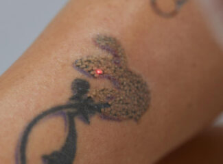 Cores difíceis e tons de pele: o que realmente define o número de sessões para apagar sua tatuagem