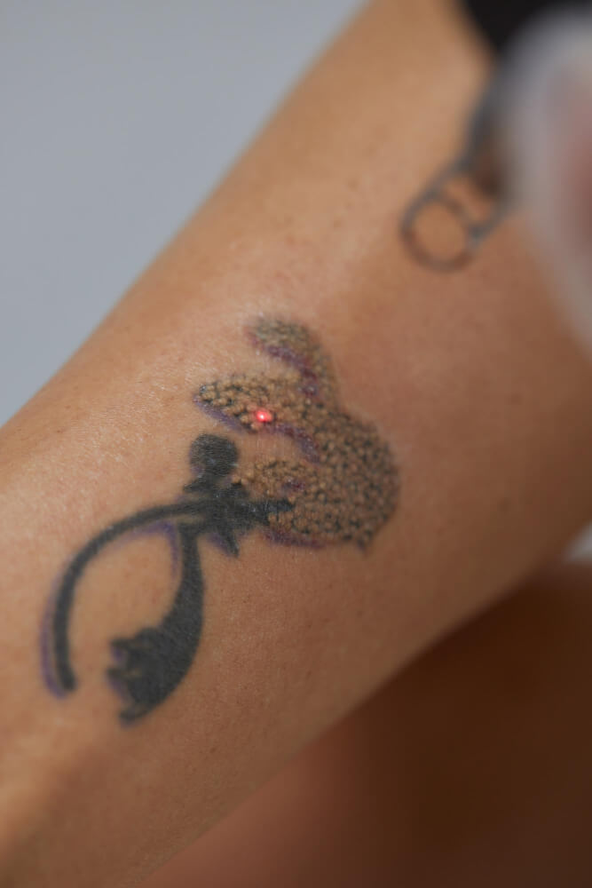 vem passando por procedimento de remoção de tatuagem a laser